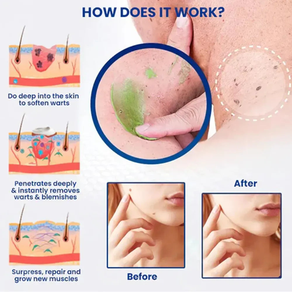 Remove excess marks within 7 days, no surgery, no discomfort, and no $500 clinic fee.